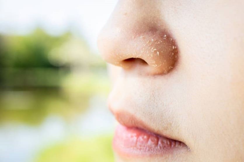 Dermatitis seborreica causas y tratamientos