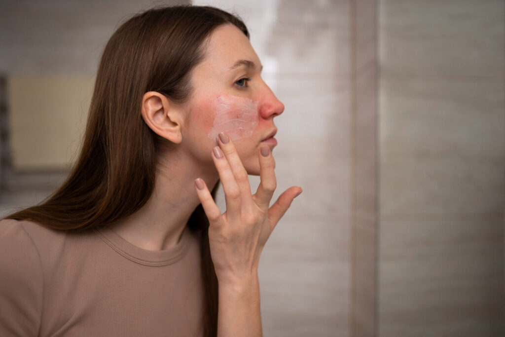 dermatitis atópica en la cara